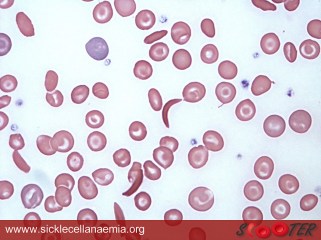 sickle cell (sicklecellanaemia.org)